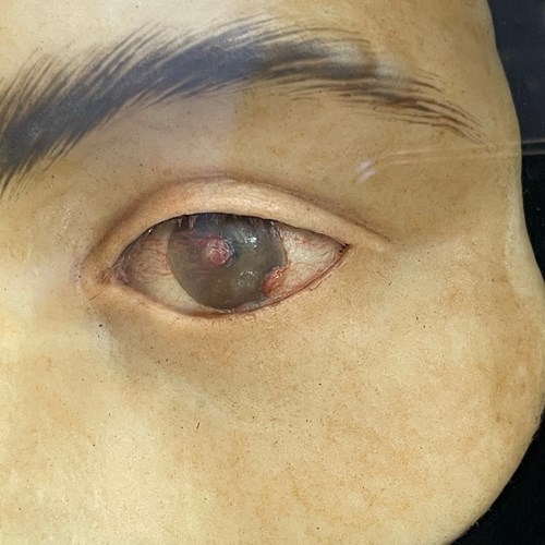 Case Of Eye Disfigurements